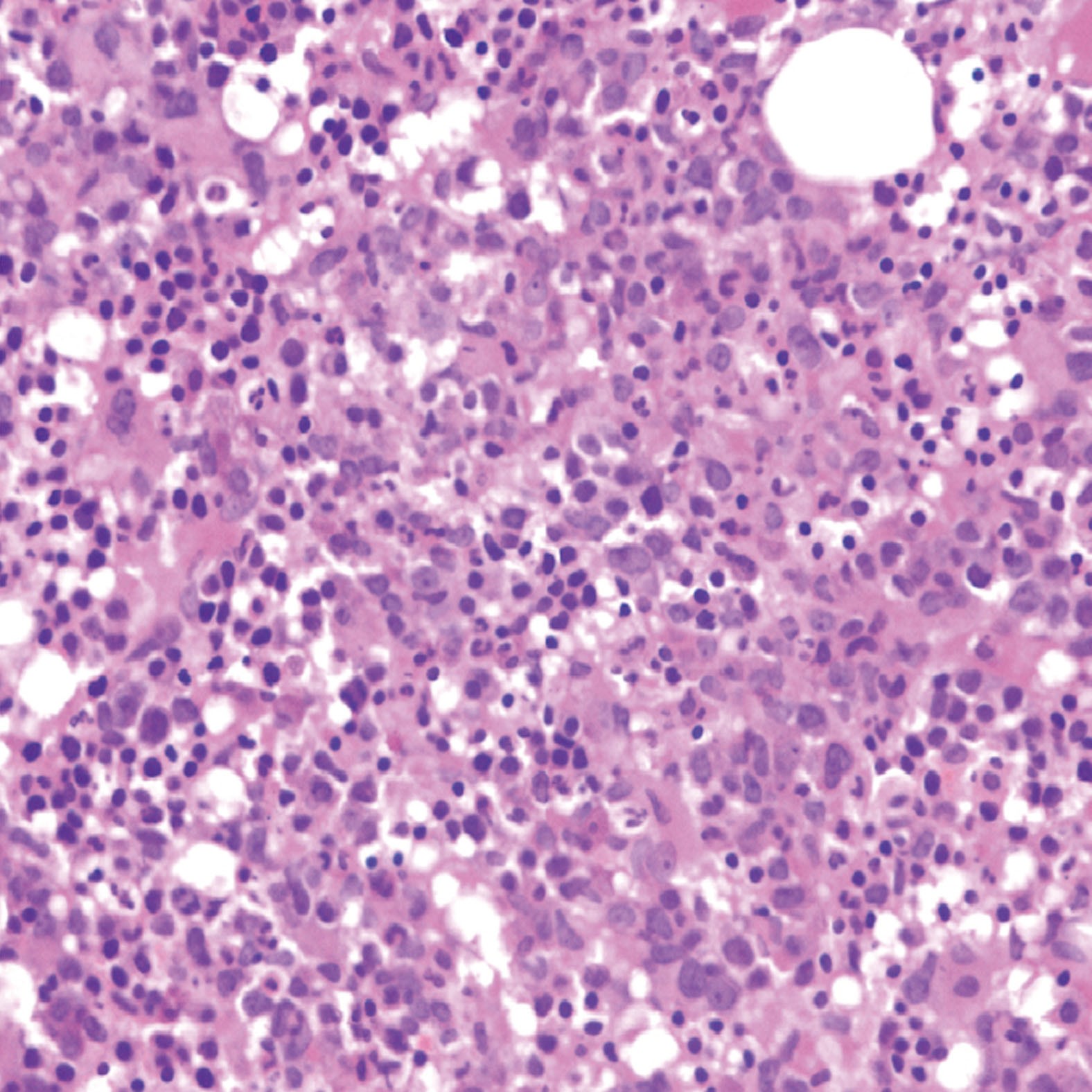 组织活检+IHC